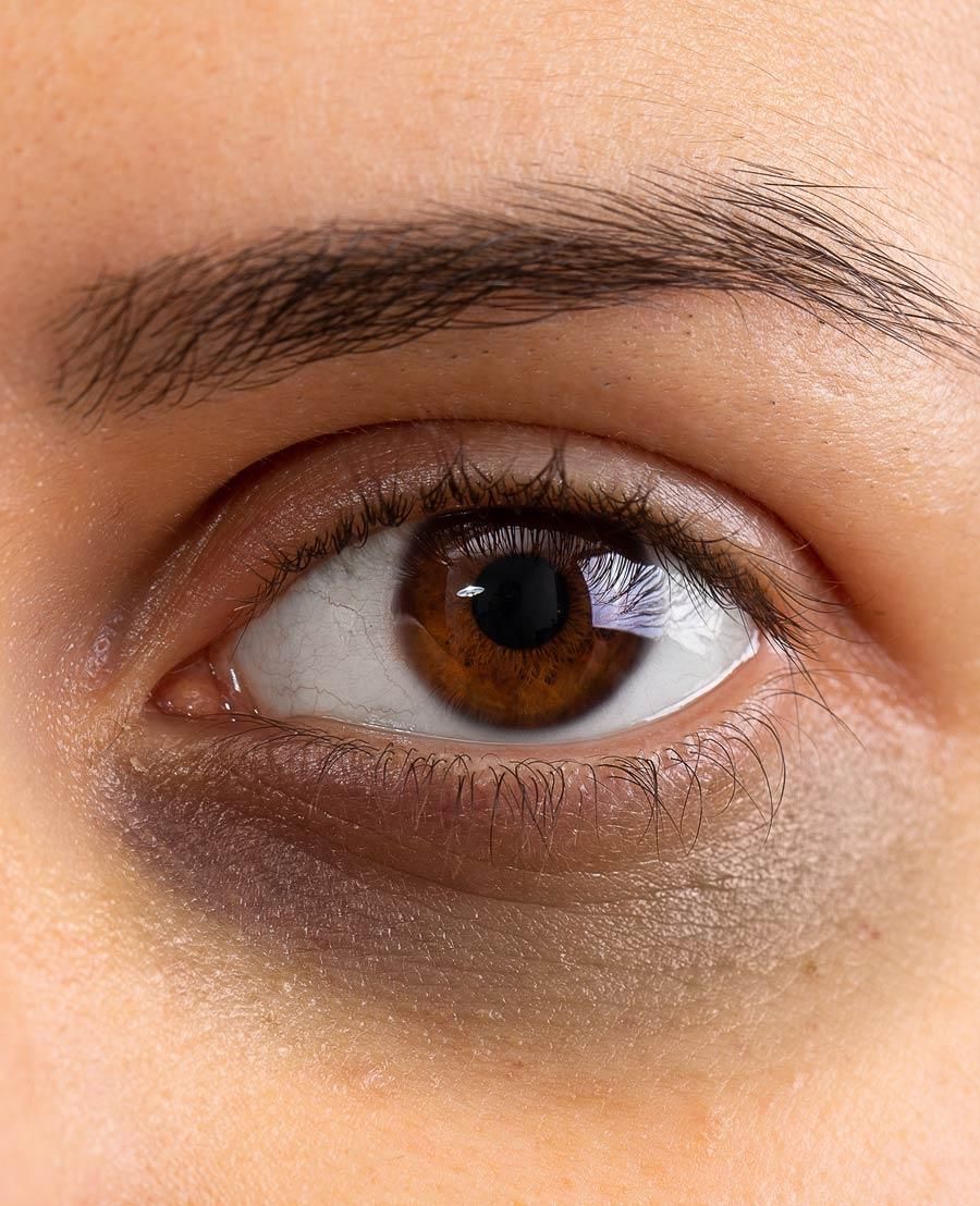 How to Reduce Dark Circles and Puffy Eyes in Pakistan