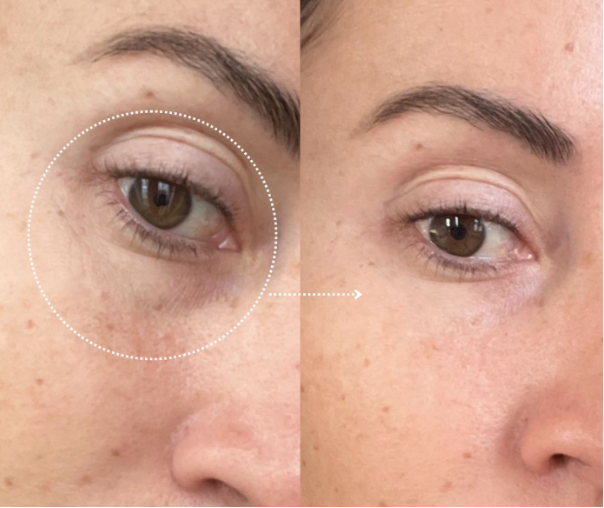 What Causes Dark Circles Under Eyes? 7 Common Reasons