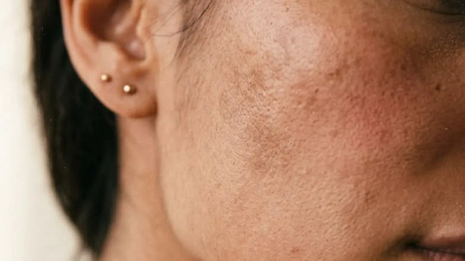 Chhaiyan Ka Ilaj: Dark Spots Aur Uneven Skin Tone Ko Improve Karne Ka Safe Tareeqa