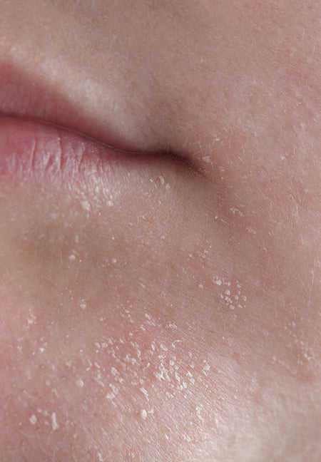 Dryness & Dehydration